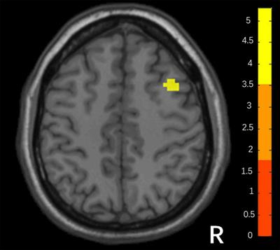 The functional connectivity of the middle frontal cortex predicts ketamine’s outcome in major depressive disorder